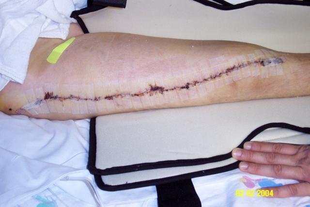 Billy's Incision
